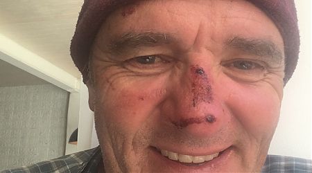 Nose damage after falling onto a rock. | Queenstown, after Rees Dart Track