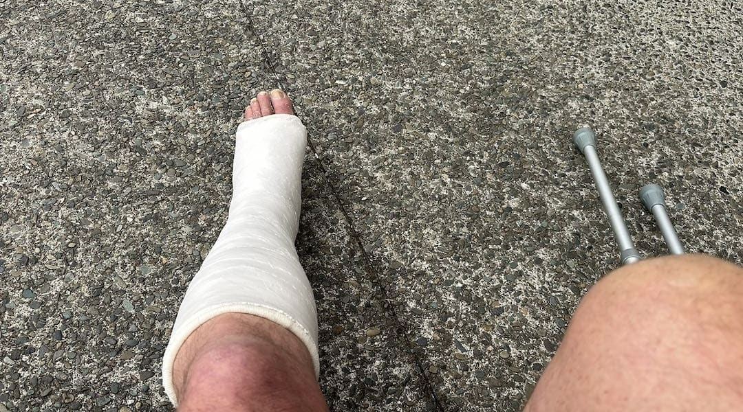 It was Day 18 after my initial tear that I was put in a cast. | Achilles tear